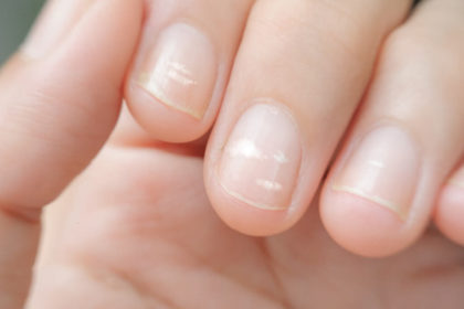 How to Get Rid of White Spots on Nails